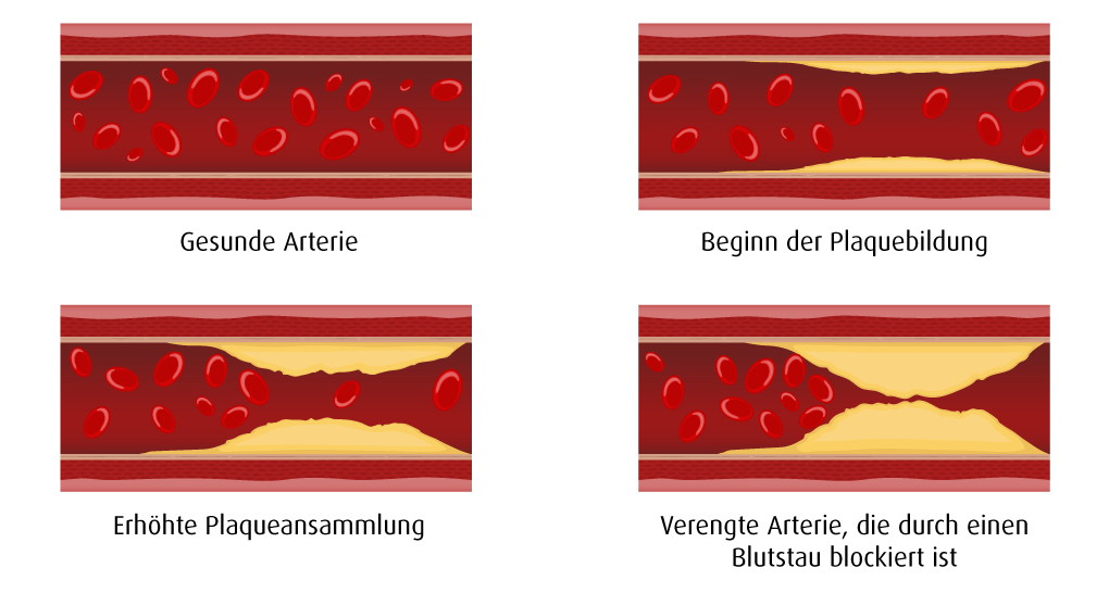 Arteriosklerose - A.Vogel Gesundheitslexikon | A.Vogel