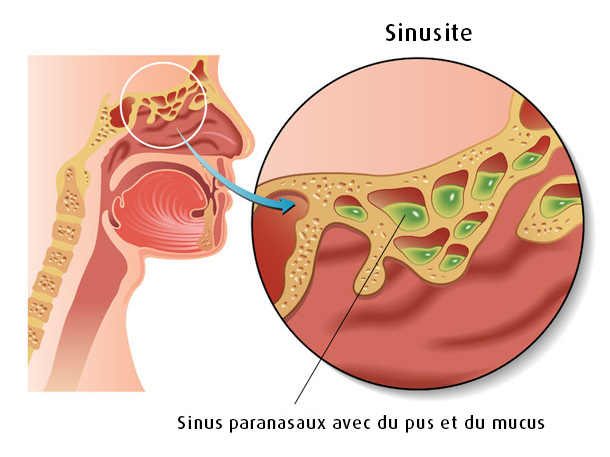 Inflammation des sinus frontaux (sinusite)